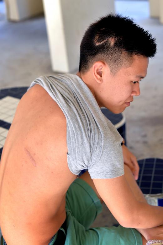 Mr Tan showing his scars from the slashing attack. 