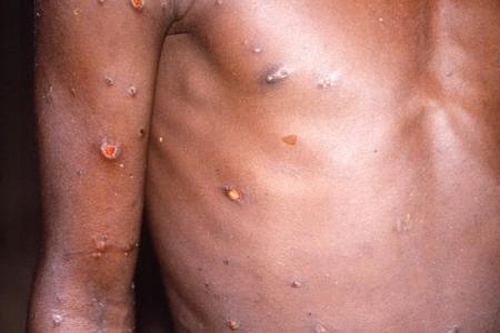 Sweden confirms first monkeypox case, France has suspected infection 