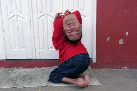 Baby with upside-down head is now a motivational speaker