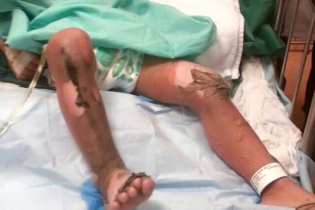 Mum: My toddler got burned saving his baby brother 