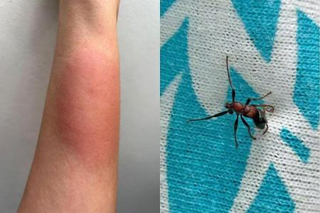 Ant bite stings man's forearm and creates big welt