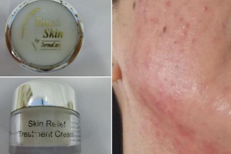 HSA warns against using skin cream with potent steroid