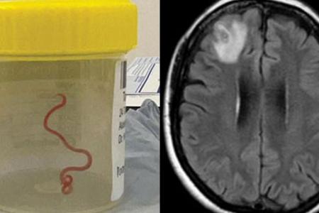 ‘Alive and wriggling’: Live worm found in woman’s brain in Australia
