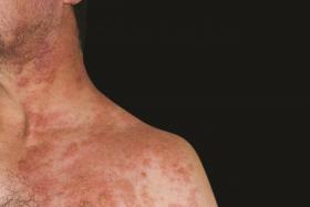 UNSIGHTLY: A person with shingles on his chest and neck. 