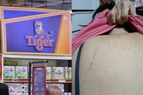 An advertising board promoting a beer brand (left) fell at NTUC FairPrice in Woodlands 888 Plaza, striking a 68-year-old woman’s back (right). The incident tore her clothing and left scratches on her skin. 