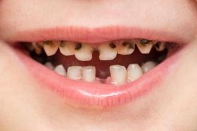 Tooth decay in very young children is especially aggressive, and when left untreated, can rapidly destroy the entire tooth and lead to infections.