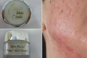 A woman suffered severe skin reactions after using Touch Skin by DermaCare Skin Relief Treatment Cream.